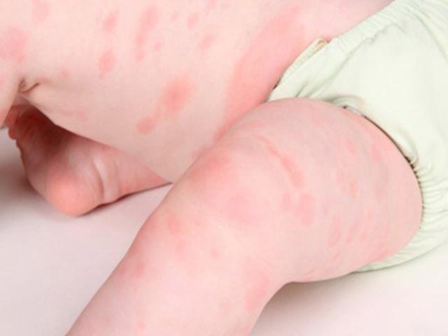 Trẻ bị dị ứng sữa là gì? - Nguyên nhân, dấu hiệu nhận biết và cách xử lý - ảnh 1