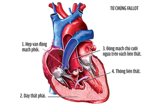 Tứ chứng Fallot là bệnh gì? có Triệu chứng như thế nào? - ảnh 2