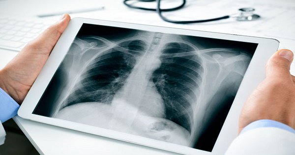 Viêm màng ngoài tim cấp - Chẩn đoán và điều trị - ảnh 1