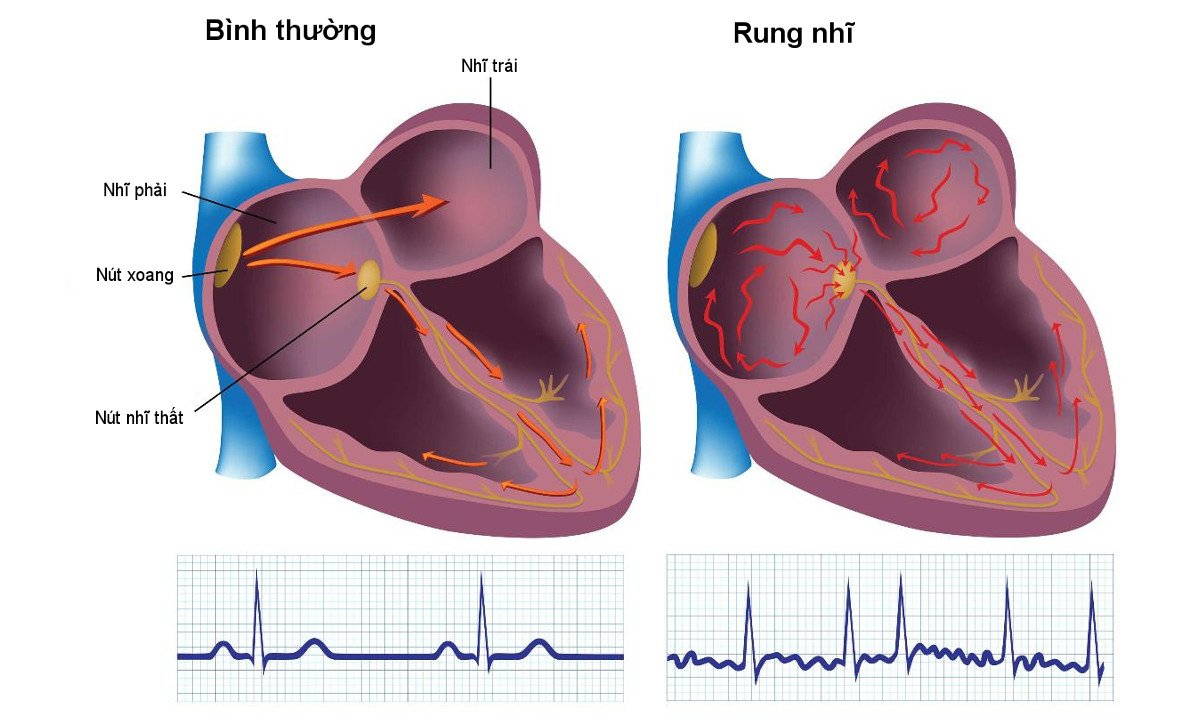 rung nhĩ là bệnh gì?, Nguyên nhân, dấu hiệu và Điều trị - ảnh 1