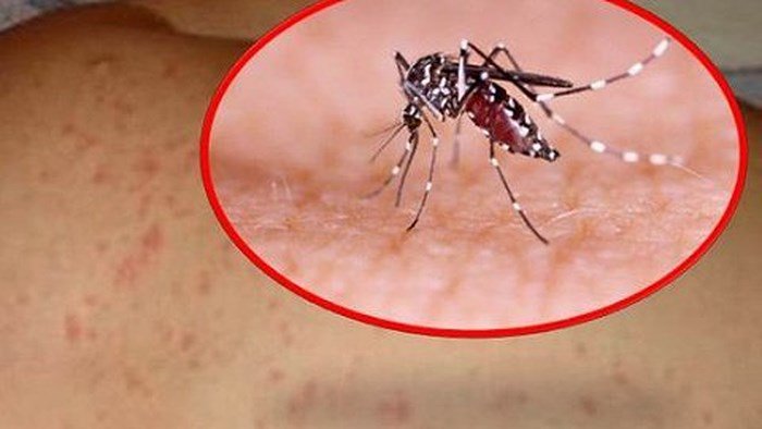 Bệnh sốt xuất huyết những điều cần biết - ảnh 1