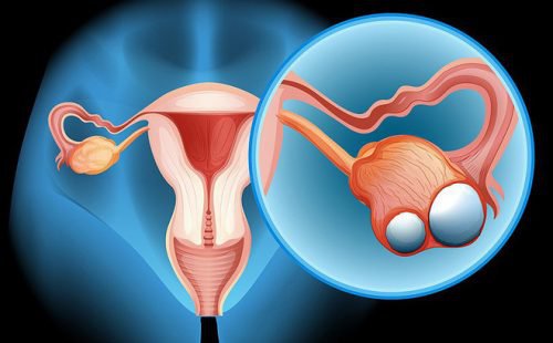Phẫu thuật nội soi cắt u nang buồng trứng những điều cần biết - ảnh 1
