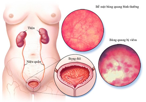 Xét nghiệm nước tiểu có bạch cầu dấu hiệu cảnh báo bệnh lý - ảnh 1