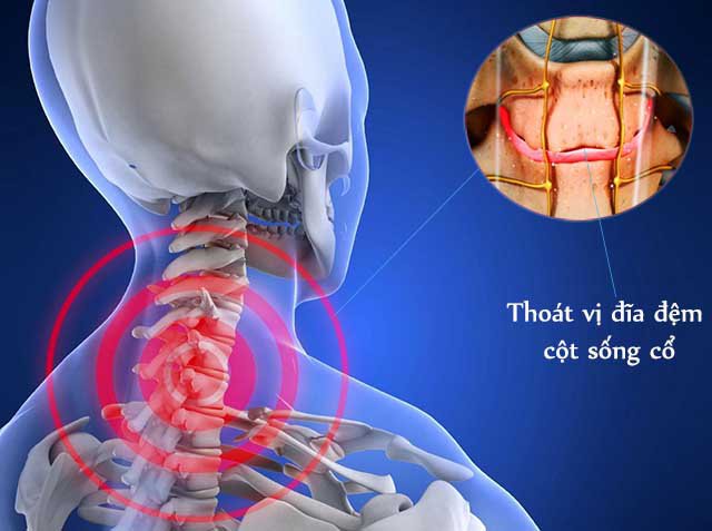 Đốt sống cổ: Đặc điểm, chức năng và Các bệnh thường gặp - ảnh 3