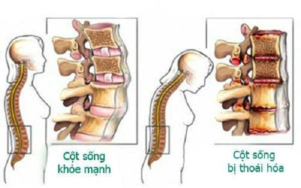 Đốt sống thắt lưng: Đặc điểm, chức năng và Các bệnh thường gặp - ảnh 2