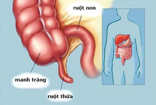 Lao hồi manh tràng là bệnh gì? Triệu chứng và Cách điều trị - ảnh 1