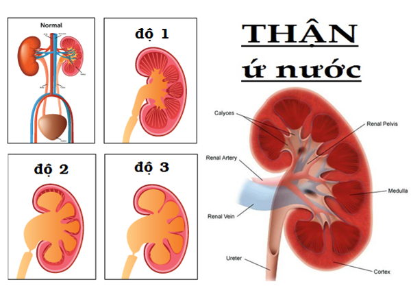 Trường hợp nào phải Cắt thận bán phần? - ảnh 1