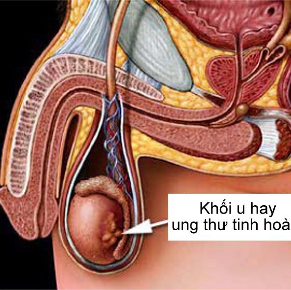 Phẫu thuật cắt bỏ tinh hoàn những điều cần biết - ảnh 1