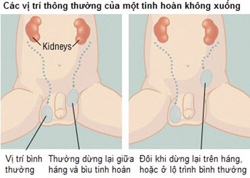 Dấu hiệu nhận biết sớm ung thư tinh hoàn - ảnh 2