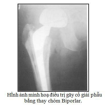 Gãy cổ xương đùi ở người cao tuổi - Điều trị và Cách phòng ngừa - ảnh 2