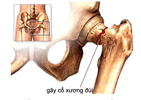 Gãy cổ xương đùi ở người cao tuổi - Điều trị và Cách phòng ngừa - ảnh 1