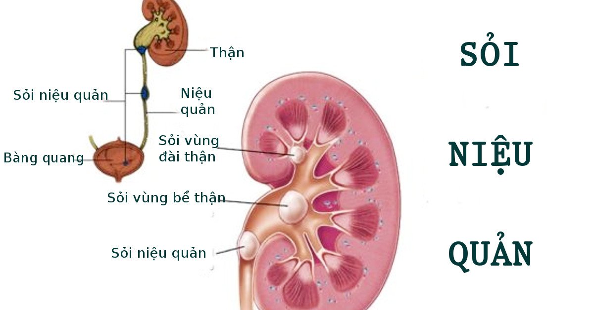 Tán sỏi ngoài cơ thể: Không đau, không cần gây mê, ít sót sỏi - ảnh 1