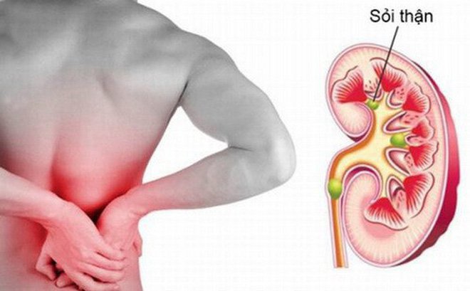 Sỏi thận 6-7mm có nguy hiểm không? nên uống thuốc hay nên phẫu thuật? - ảnh 1