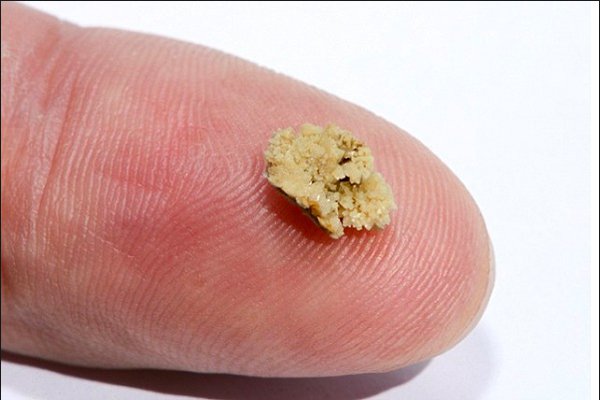 Sỏi thận 6-7mm có nguy hiểm không? nên uống thuốc hay nên phẫu thuật? - ảnh 2