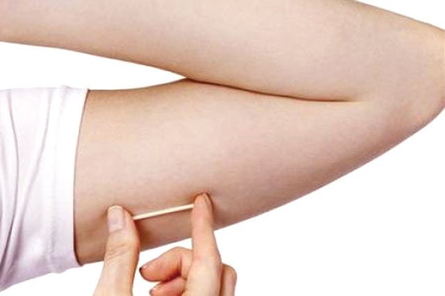 Hiệu quả tránh thai của que cấy Implanon - ảnh 1