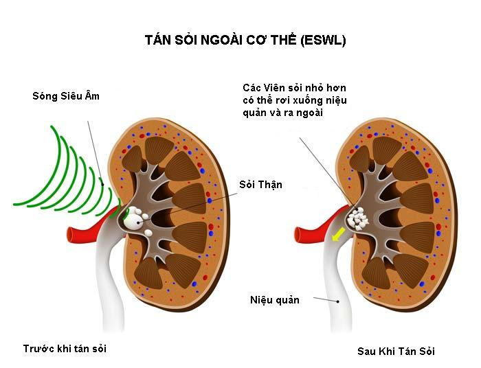 Các phương pháp tán sỏi thận - tiết niệu - ảnh 1