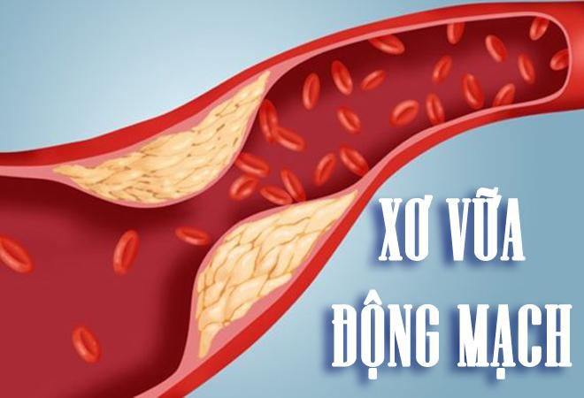 Chuẩn đoán chính xác mức độ xơ vữa động mạch vành nhờ kỹ thuật siêu âm hiện đại - ảnh 1