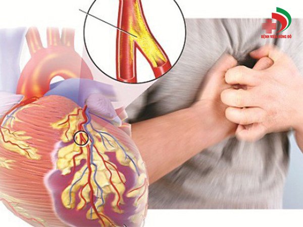 Ưu điểm vượt trội của siêu âm IVUS trong điều trị xơ vữa động mạch vành - ảnh 1