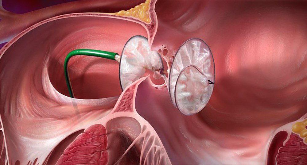 Đóng lỗ thông liên nhĩ bằng kỹ thuật mổ tim hở ít xâm lấn - ảnh 1