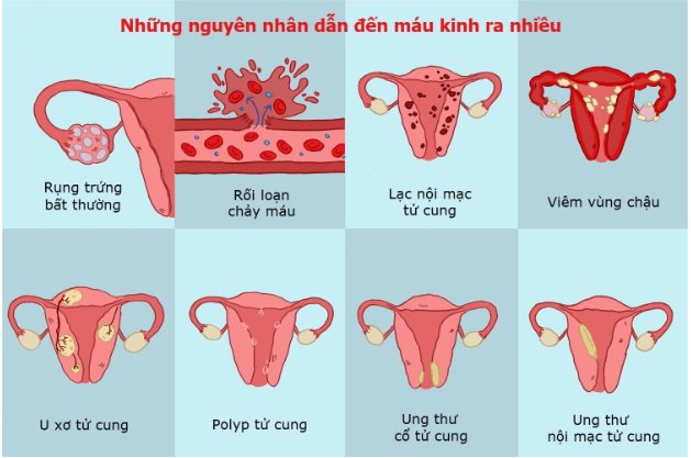 Nguyên nhân chảy máu kinh nguyệt nhiều - ảnh 2