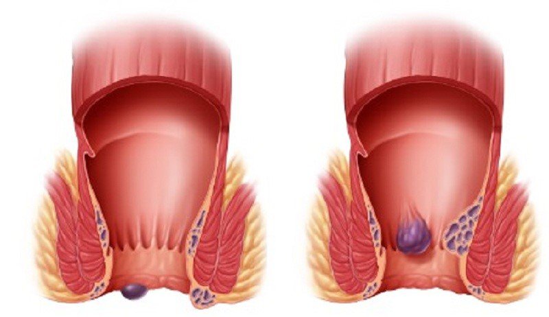Bệnh trĩ là bệnh gì? Triệu chứng và Cách điều trị - ảnh 1
