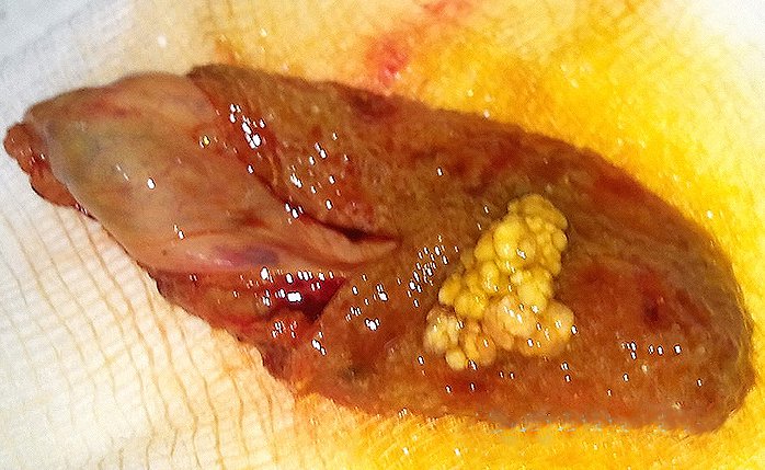Sỏi túi mật là bệnh gì? Nguyên nhân, triệu chứng, chẩn đoán và cách xử trí - ảnh 3