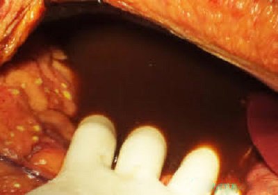 Sỏi túi mật là bệnh gì? Nguyên nhân, triệu chứng, chẩn đoán và cách xử trí - ảnh 10