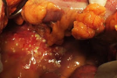 Sỏi túi mật là bệnh gì? Nguyên nhân, triệu chứng, chẩn đoán và cách xử trí - ảnh 11