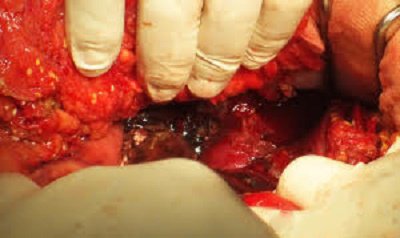 Sỏi túi mật là bệnh gì? Nguyên nhân, triệu chứng, chẩn đoán và cách xử trí - ảnh 12
