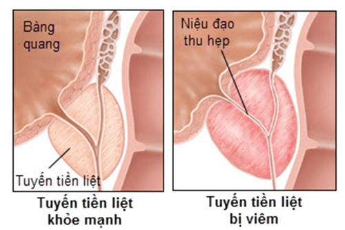 Nội soi cắt u xơ tuyến tiền liệt lành tính - ảnh 1