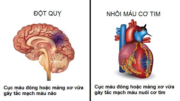 Phân biệt đột quỵ với nhồi máu cơ tim