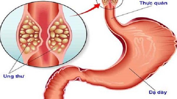 Mở thông dạ dày nuôi dưỡng bệnh nhân ung thư thực quản - ảnh 1