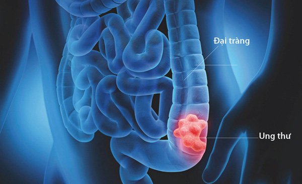 Ung thư đại tràng