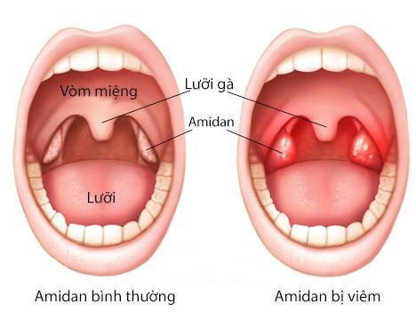 Viêm họng: Bệnh tưởng nhẹ nhưng chớ coi thường