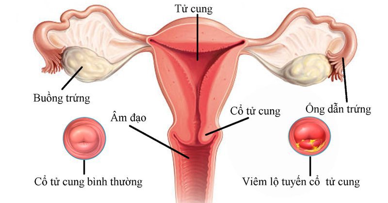 Bệnh thường gặp ở cổ tử cung