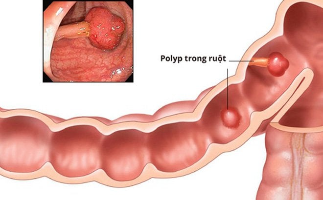 Nội soi cắt polyp ống tiêu hóa > 1cm hoặc đa polyp - ảnh 1