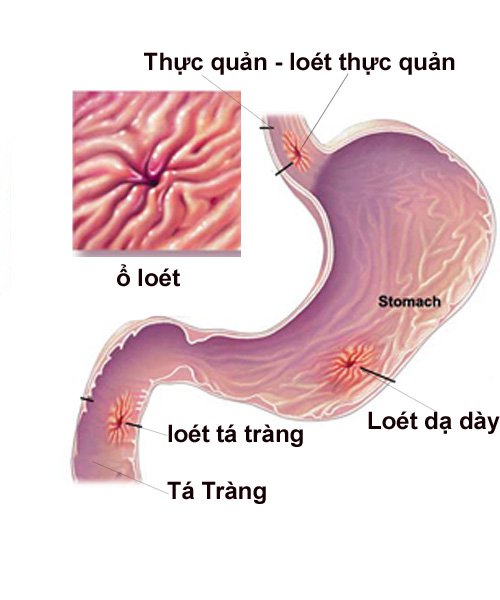 Có thể thủng dạ dày nếu bị viêm loét dạ dày nặng - ảnh 1