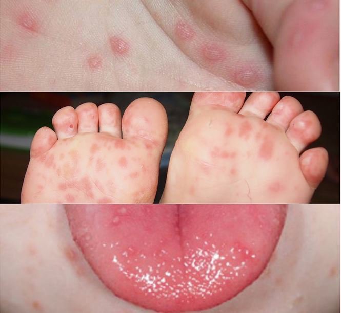 Bệnh tay chân miệng trẻ em