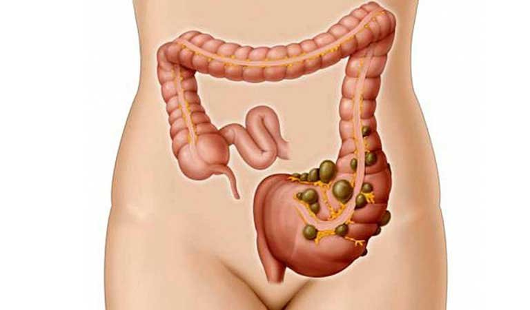 Viêm túi thừa đại tràng