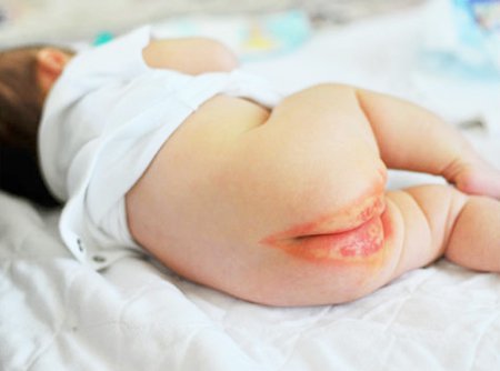 Nứt kẽ hậu môn ở trẻ là gì? nguyên nhân và cách điều trị - ảnh 2