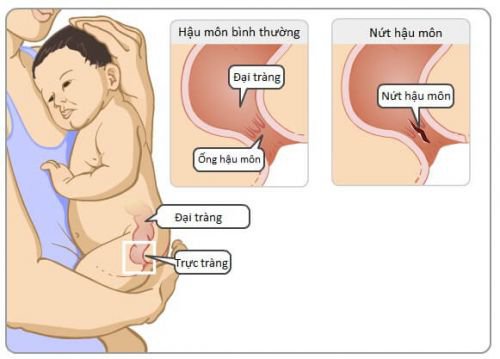 Nứt kẽ hậu môn ở trẻ là gì? nguyên nhân và cách điều trị - ảnh 1