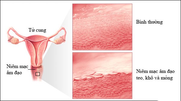 Niêm mạc âm đạo bị teo