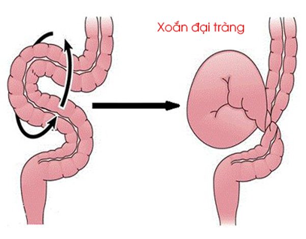 Xoắn đại tràng