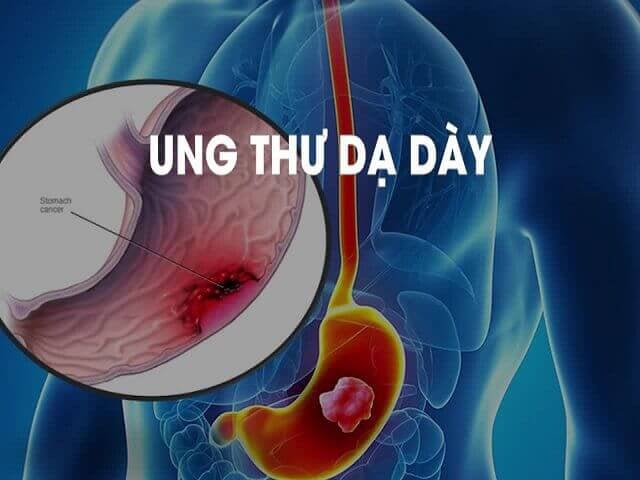 Vai trò của nạo vét hạch trong điều trị ung thư dạ dày - ảnh 1