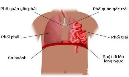 Thoát vị hoành: Những điều cần biết - ảnh 1