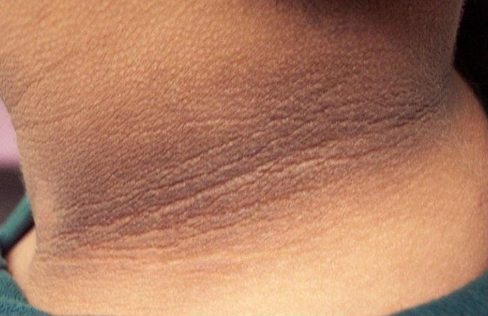 Bệnh gai đen (acanthosis nigricans) có nguy hiểm không? - ảnh 1