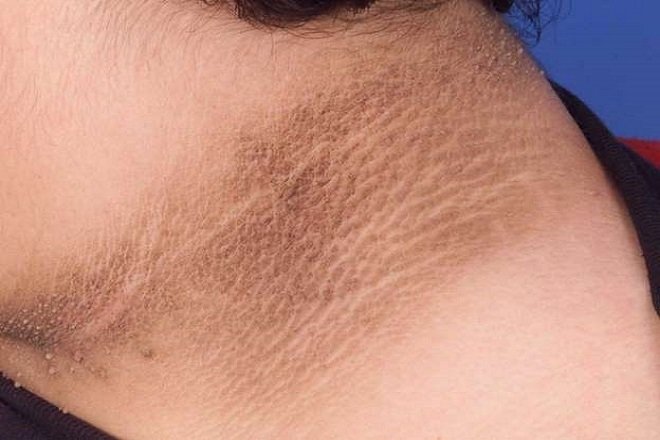 Bệnh gai đen (acanthosis nigricans) có nguy hiểm không? - ảnh 2