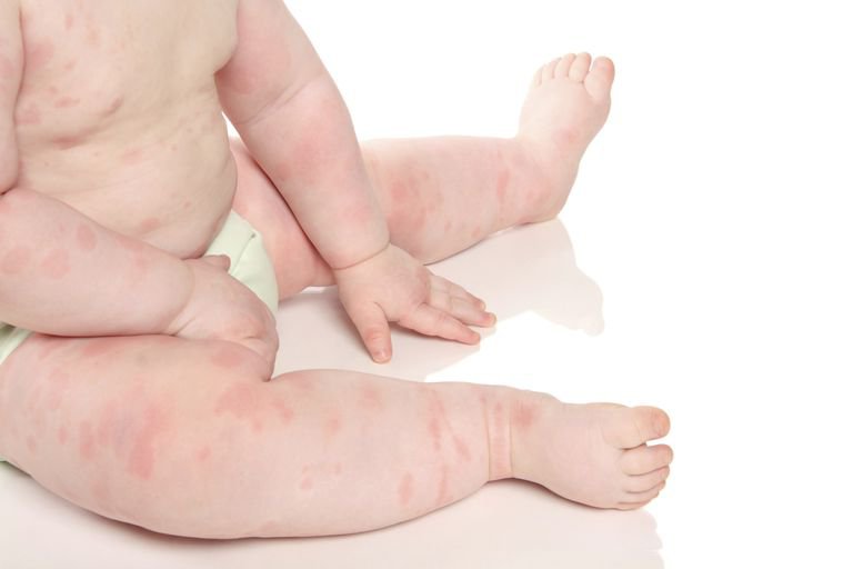 Sử dụng corticoid ở trẻ em những điều cần biết - ảnh 1