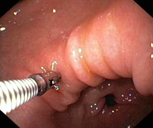 Những điều cần biết về sinh thiết dạ dày - ảnh 1