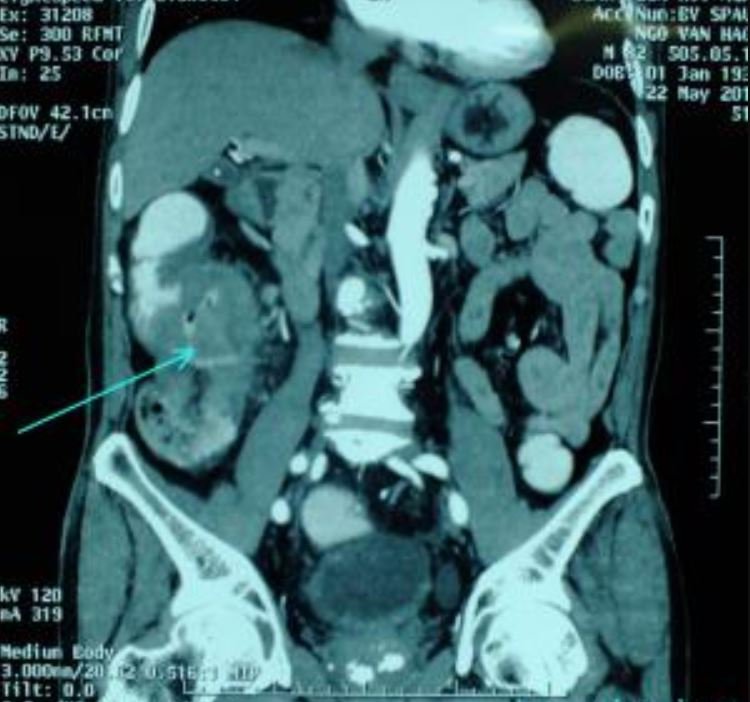 Ung thư đại tràng